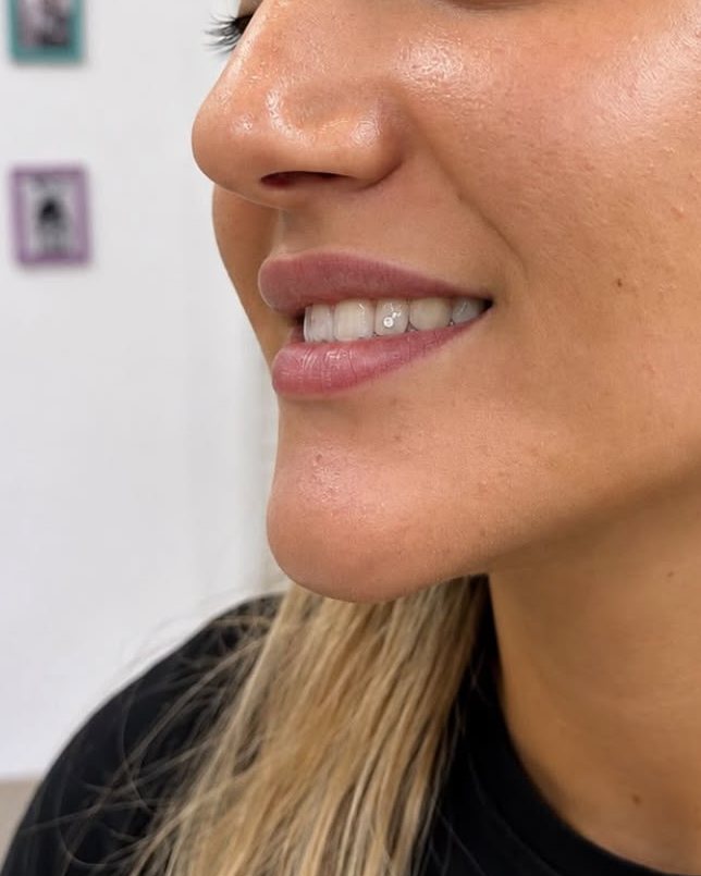 Sonrisa de perfil con una gema dental pequeña